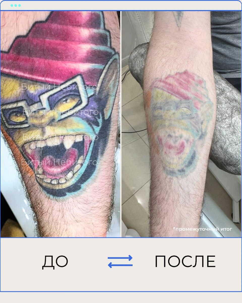 удаление цветной тату