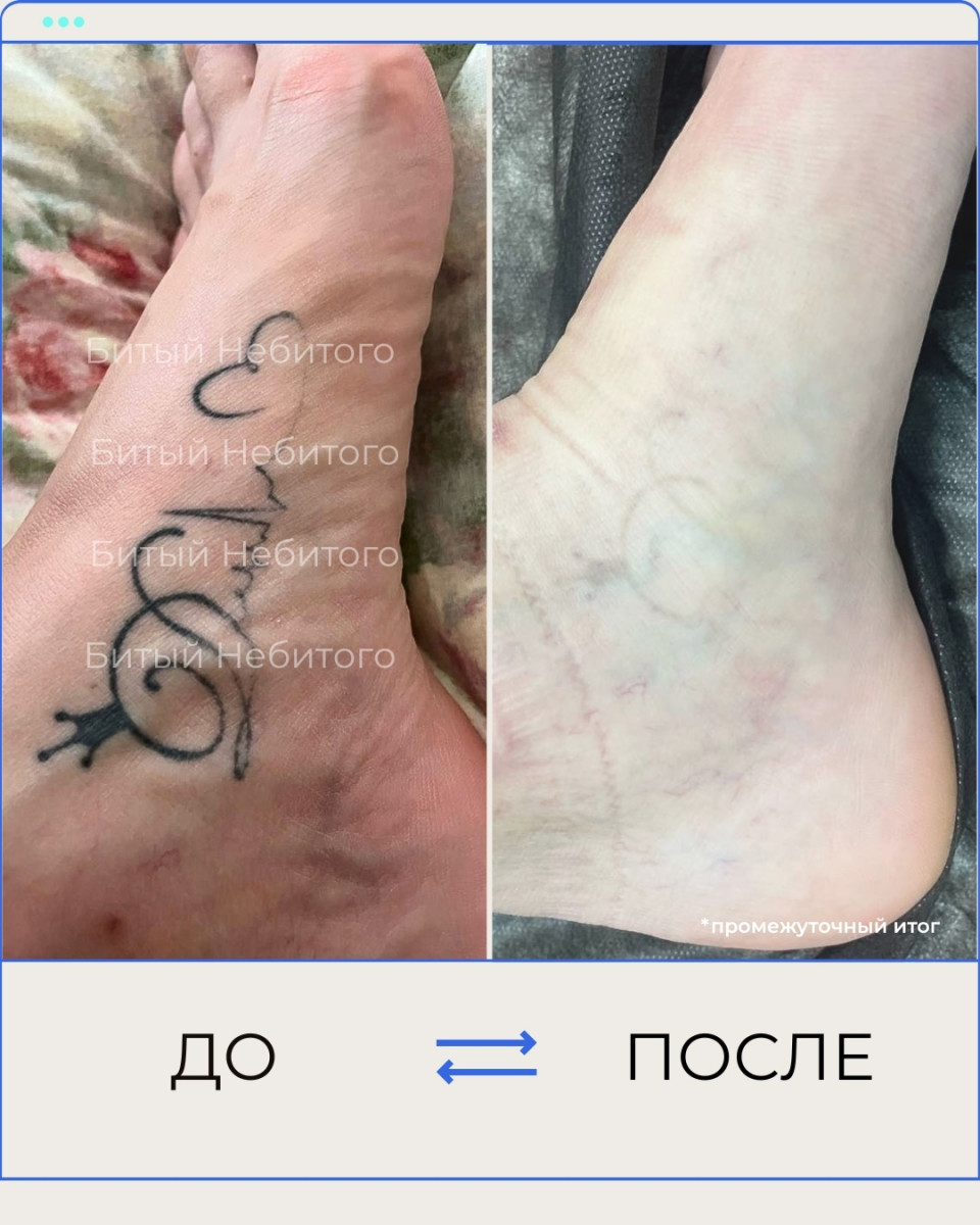 Сведение тату на ноге