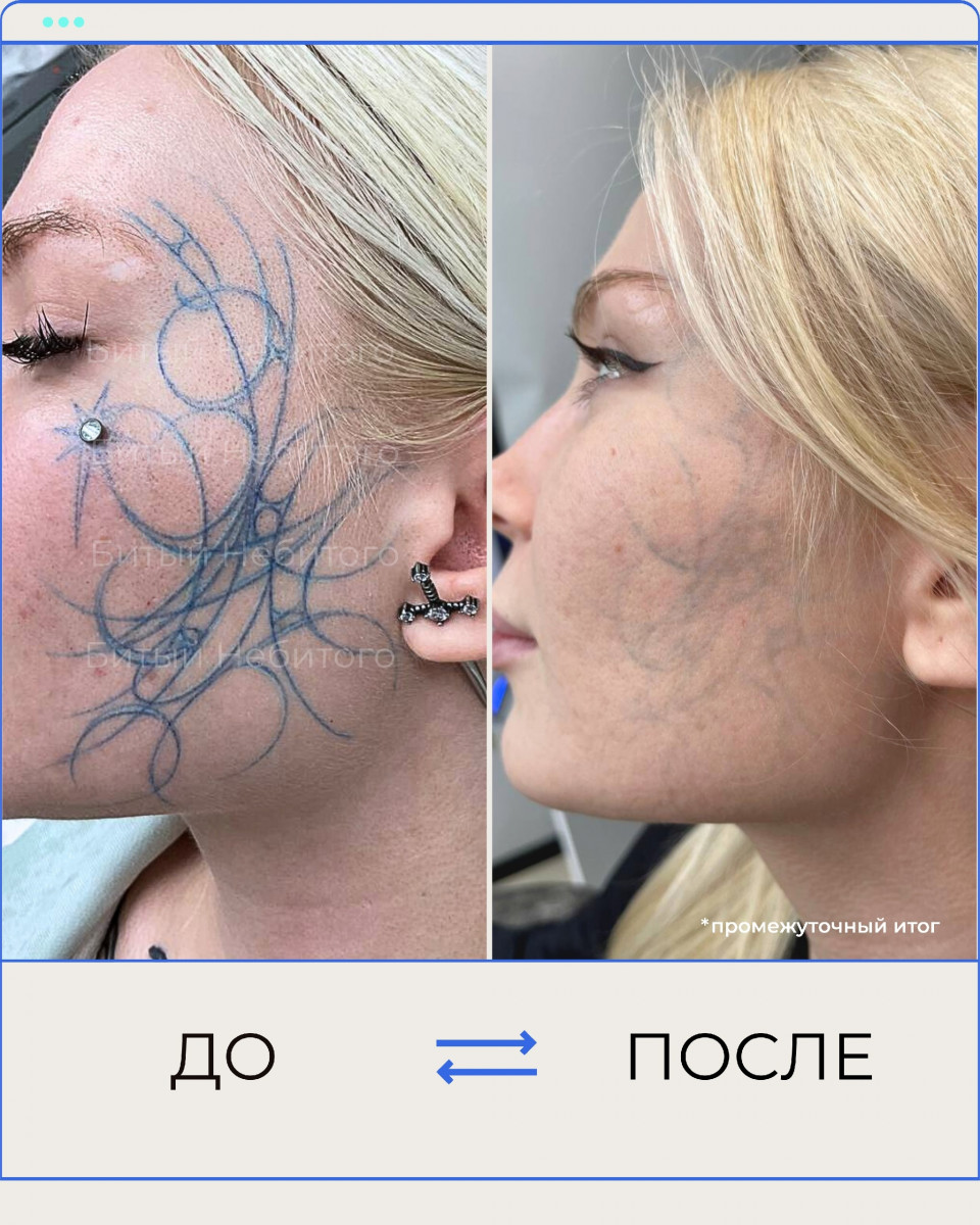 удаление тату на лице