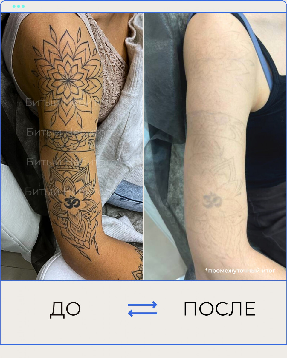 Сведение тату на плече