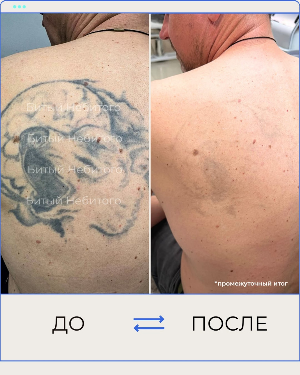 Удаление тату на лопатке
