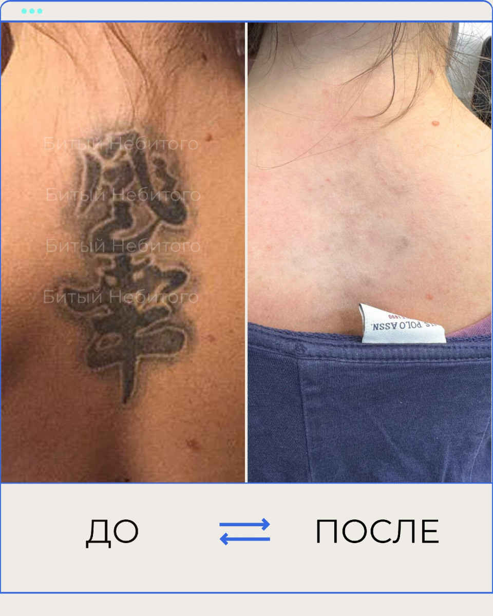 удаление тату на спине 